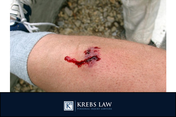 Steps After a Dog Bite Incident